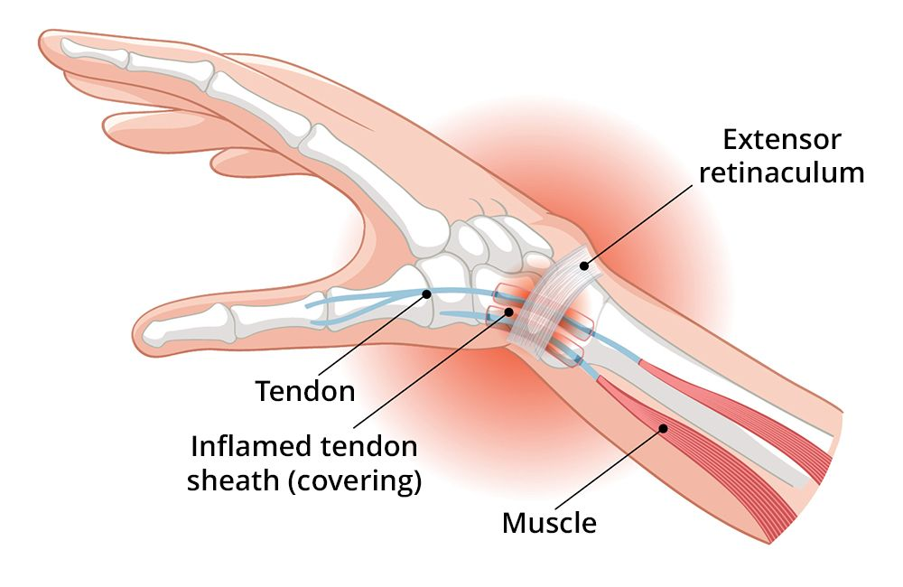 De Quervain's Synovitis
