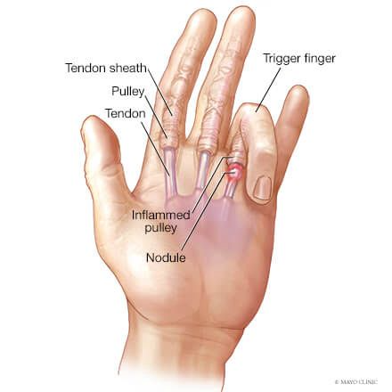 Trigger Finger