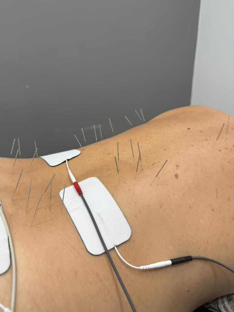 Rehabilitation & Dry Needling