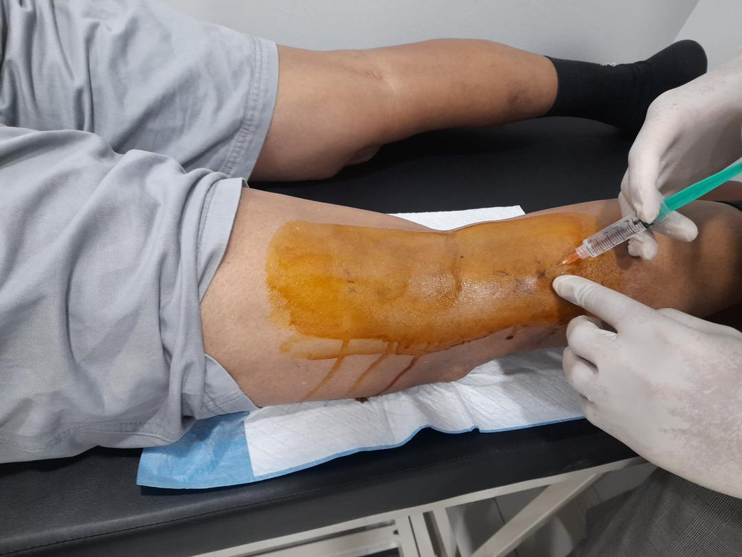 PRP Therapy