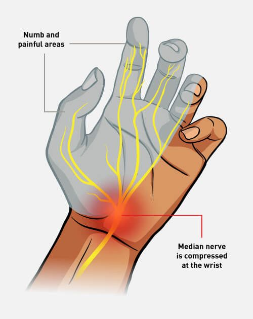 Carpal Tunnel Syndrome