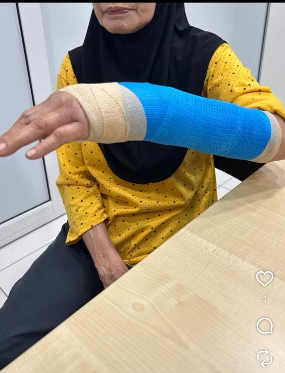Fibreglass Cast
