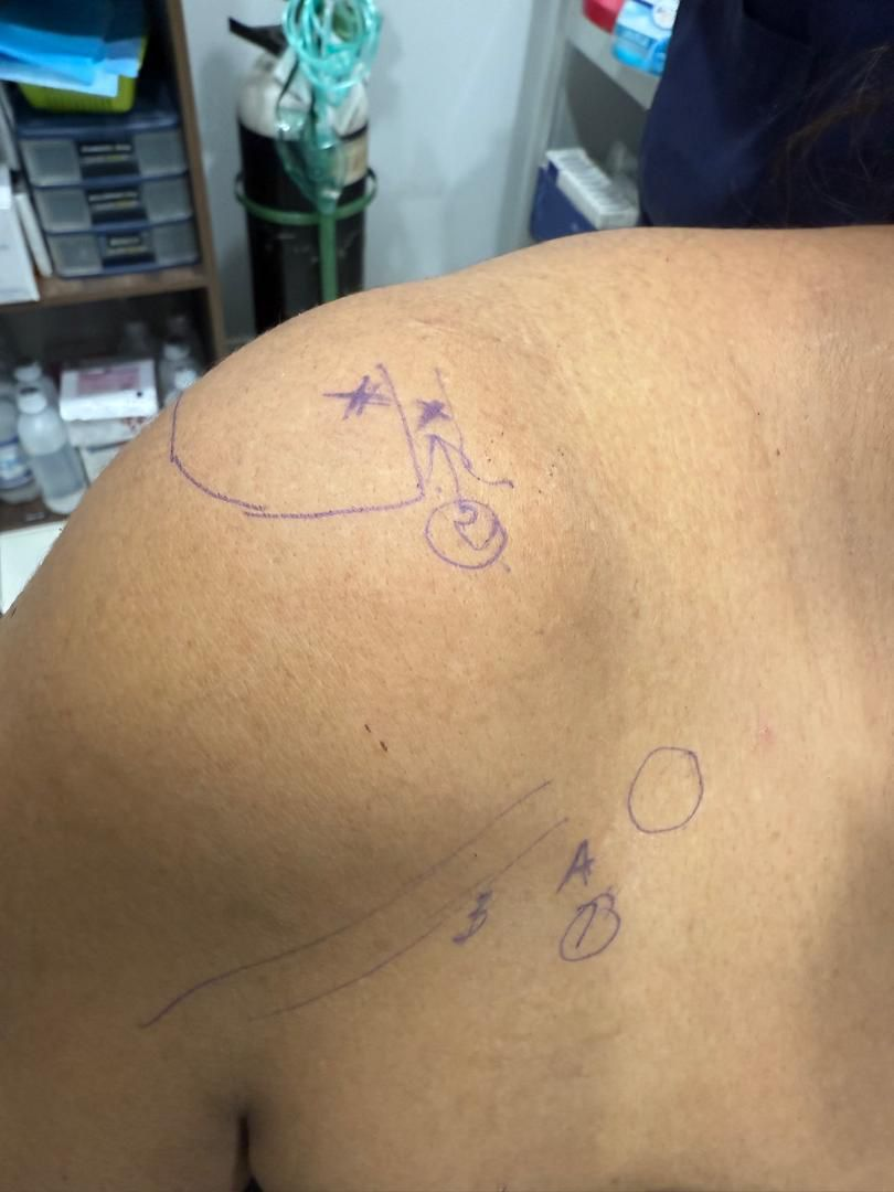 Frozen Shoulder