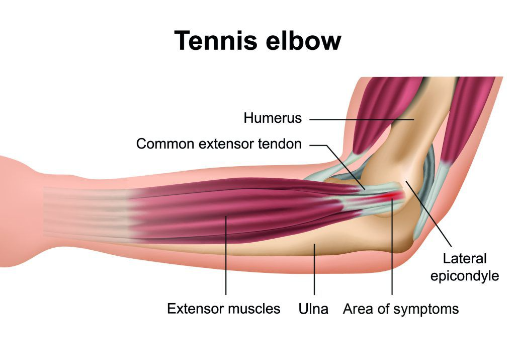 Tennis & Golfer's Elbow